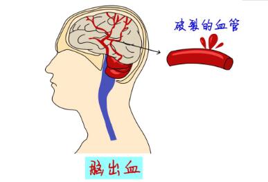 经颅磁的刺激作用|脑出血都是什么原因造成的